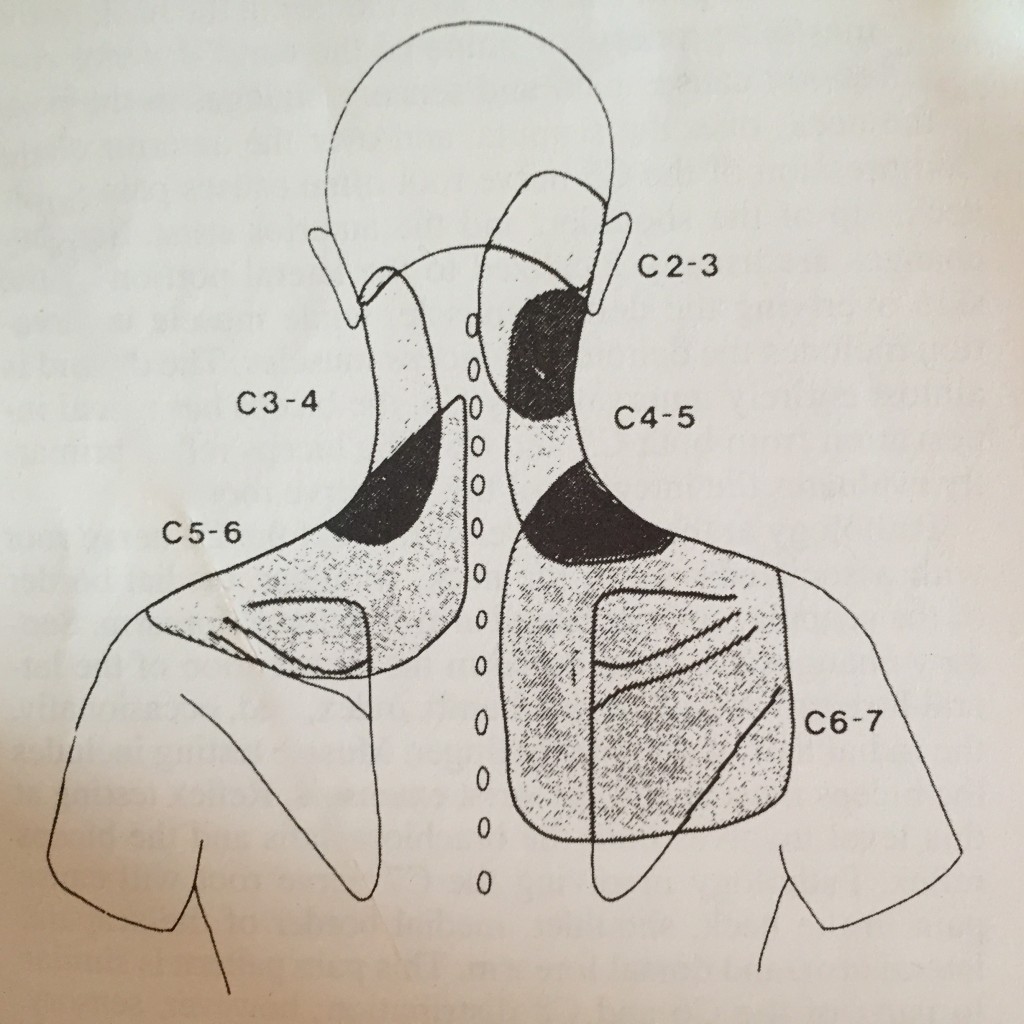 Areas of Referred Pain from Cervical Spine Disorder