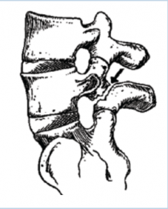 Arrow points to crack in vertebra