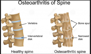 Arthritis of the Spine