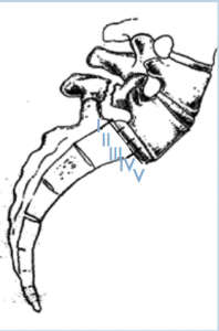 Grades I - IV show degree of slippage