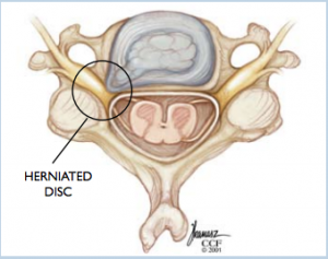 Herniated Cervical Disc