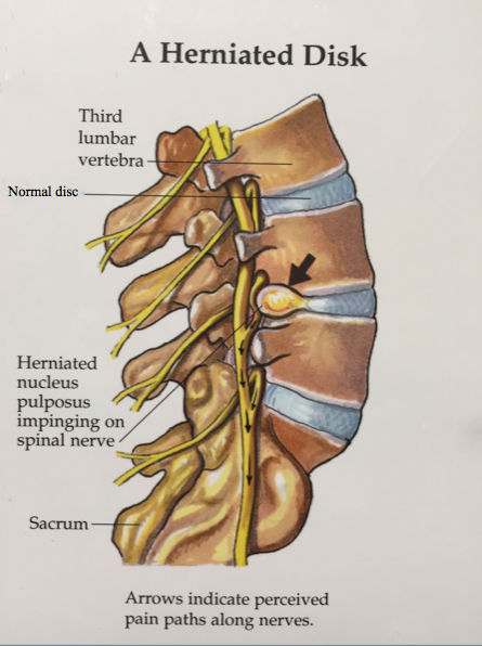 herniated discs exercises