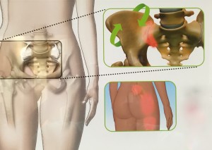 SI Joint Symptomology