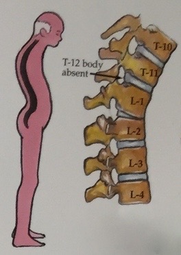 Kyphosis