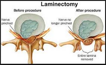 Laminectomy