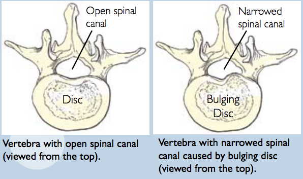 Lumbar Spinal Stenosis