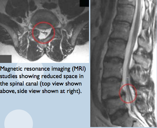 Lumbar spinal stenosis (MRI)