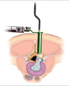 Min_Inv_Discectomy