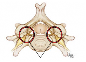 Nerve Pinched by Narrow Canal