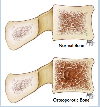 Osteoporosis normal discs