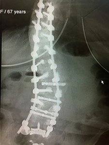 Adult Scoliosis - Post-Op