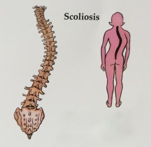 Adult Scoliosis