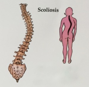 Adult Scoliosis