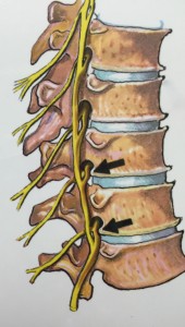 Spinal Stenosis