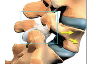 Spondylolisthesis