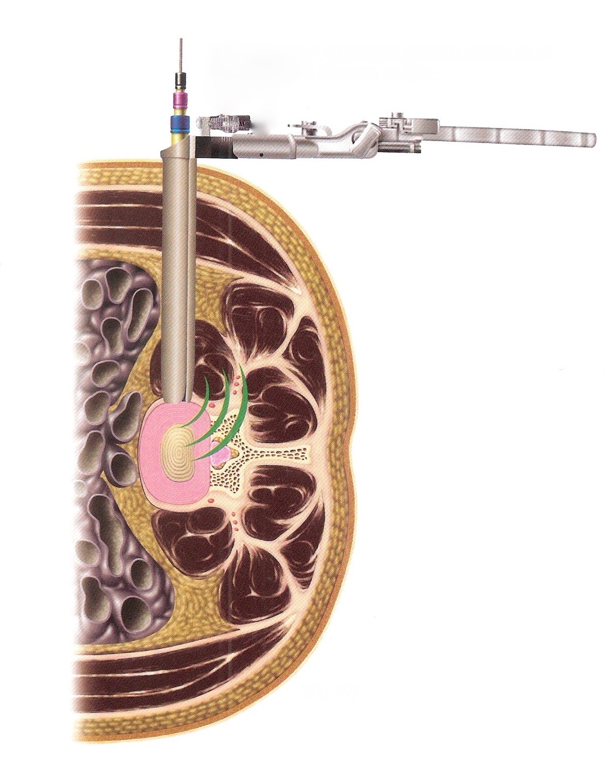 Neurovision Dynamic Stimulation Cup Attached to Center Blade