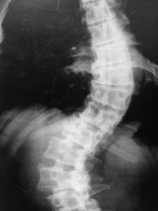 Adult Scoliosis (pre-surgical x-ray)