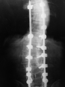 Adult Scoliosis (Post-Operative)