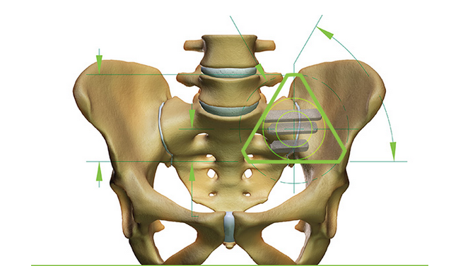 iFuse Implant System