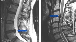 Herniated Lumbar Disc (MRI Image)