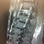Compression Fracture (MRI Image - X View)