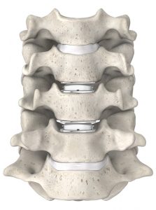 Mobi-C Artificial Disc Replacement