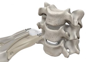 Mobi-C Artificial Disc Replacement