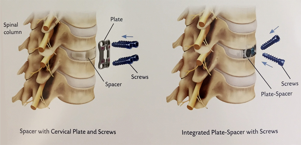 Cervical Spine Fusion