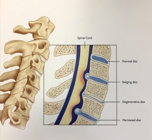 Cervical Spine Fusion